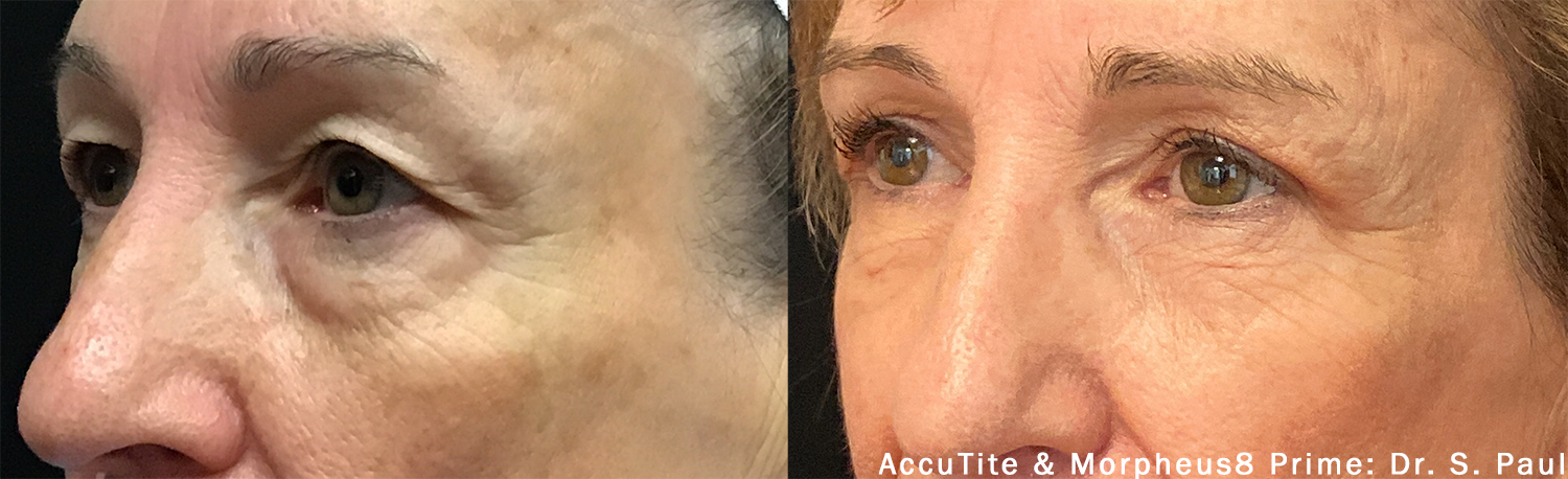 accutite-morpheus-prime-before-after-dr-s-paul-preview-2.png