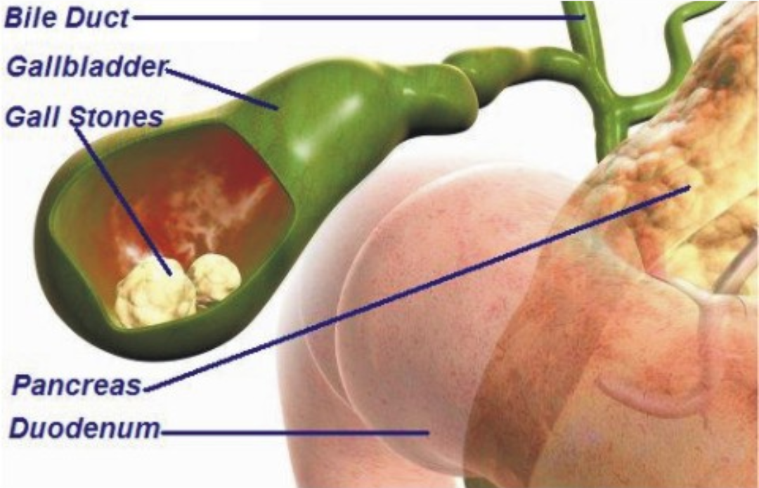 Gallstones: Causes, risk factors and prevention strategies — Claire the ...