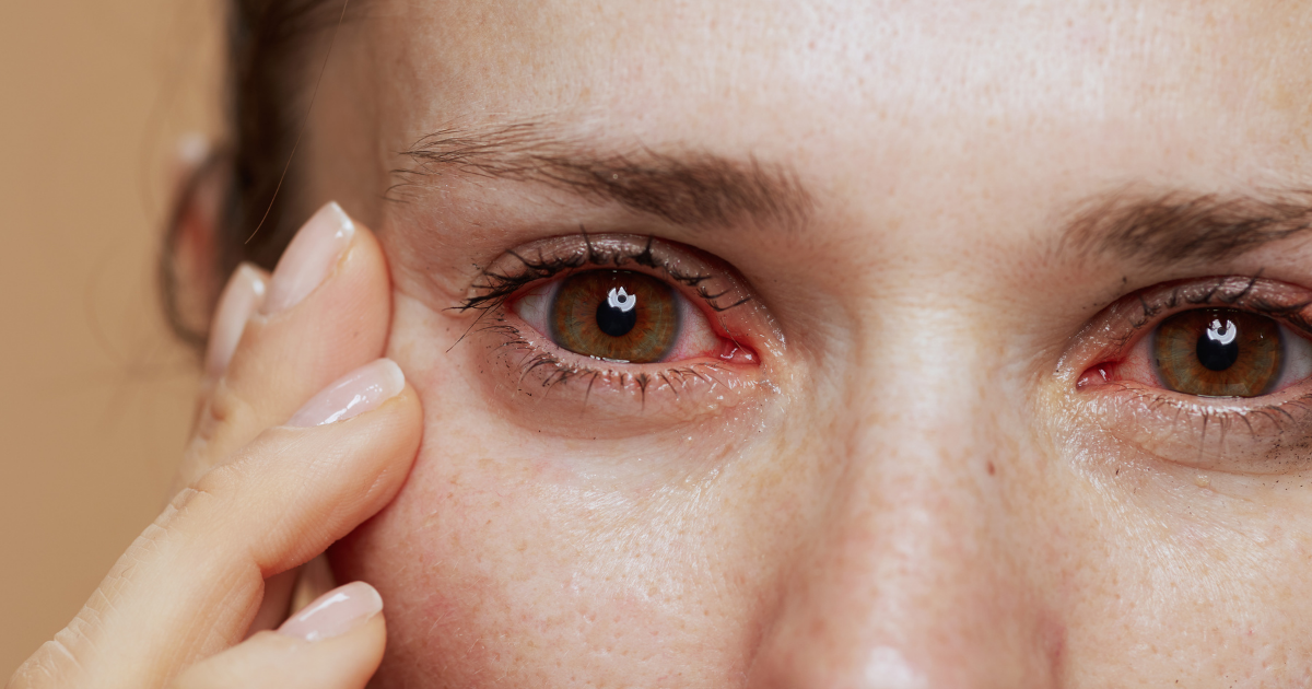 The ultimate guide to dry eye treatment