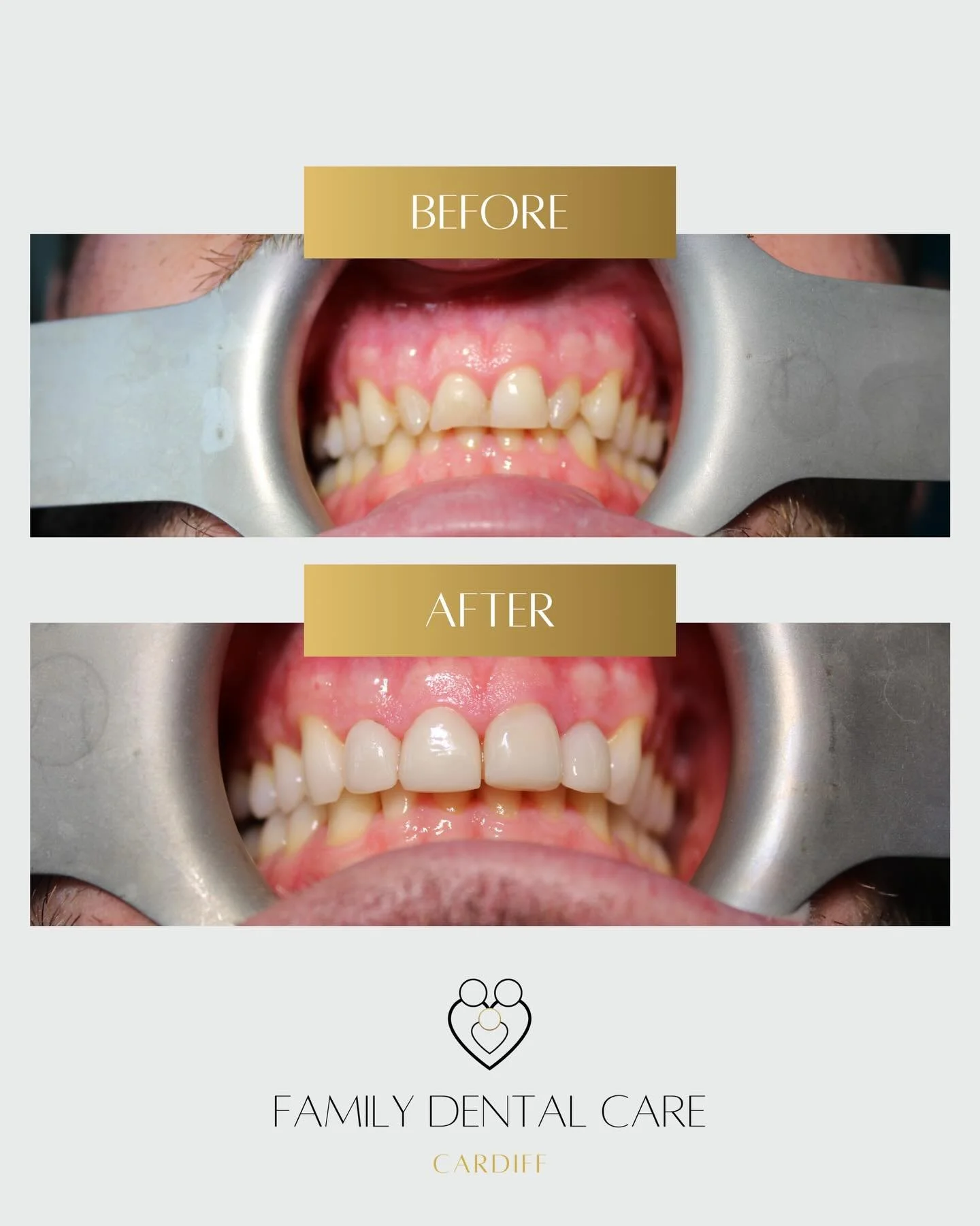 What a difference! This patient had emax veneers on his front 4 teeth and a whitening treatment. 

We love helping patients gain their confidence back with a dazzling smile ✨

If you&rsquo;d like more information about our treatments, get in touch wi