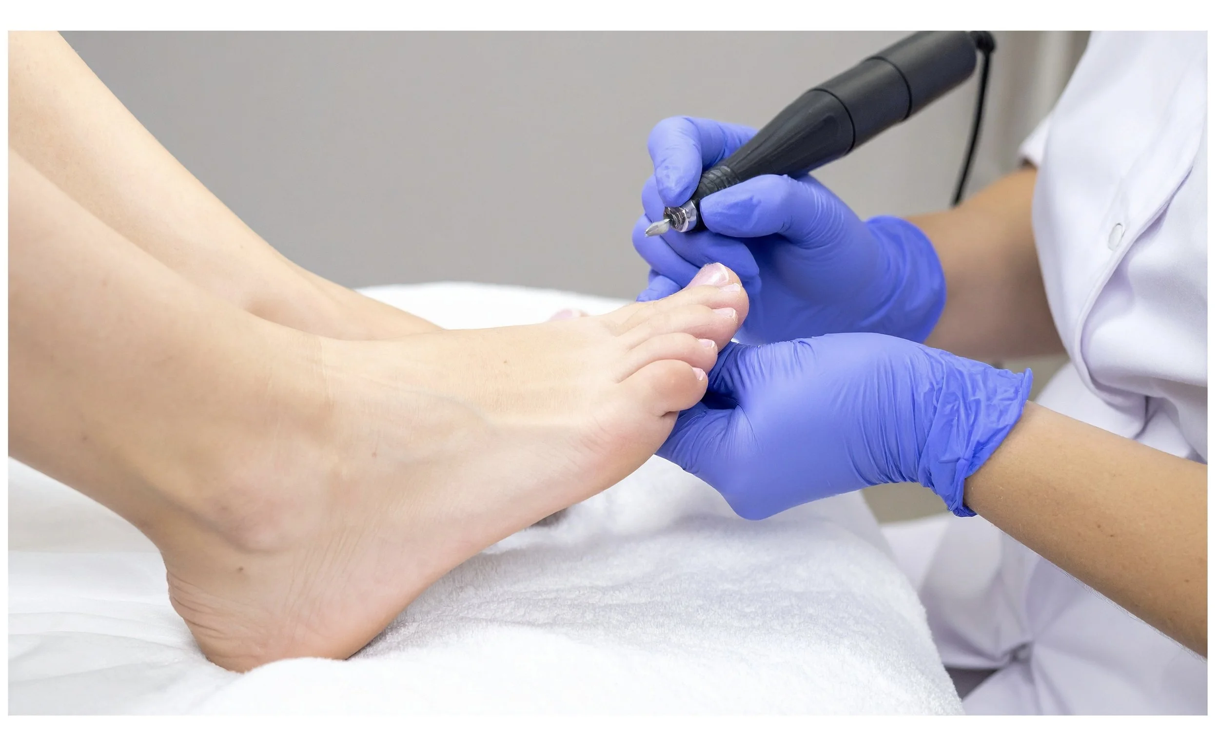 Chiropody treatment on feet