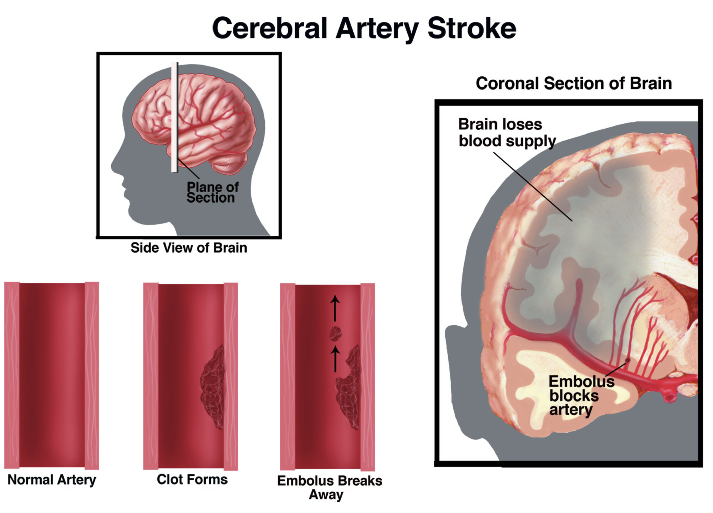 WayArt_MarieD_CerebralArteryStroke.png
