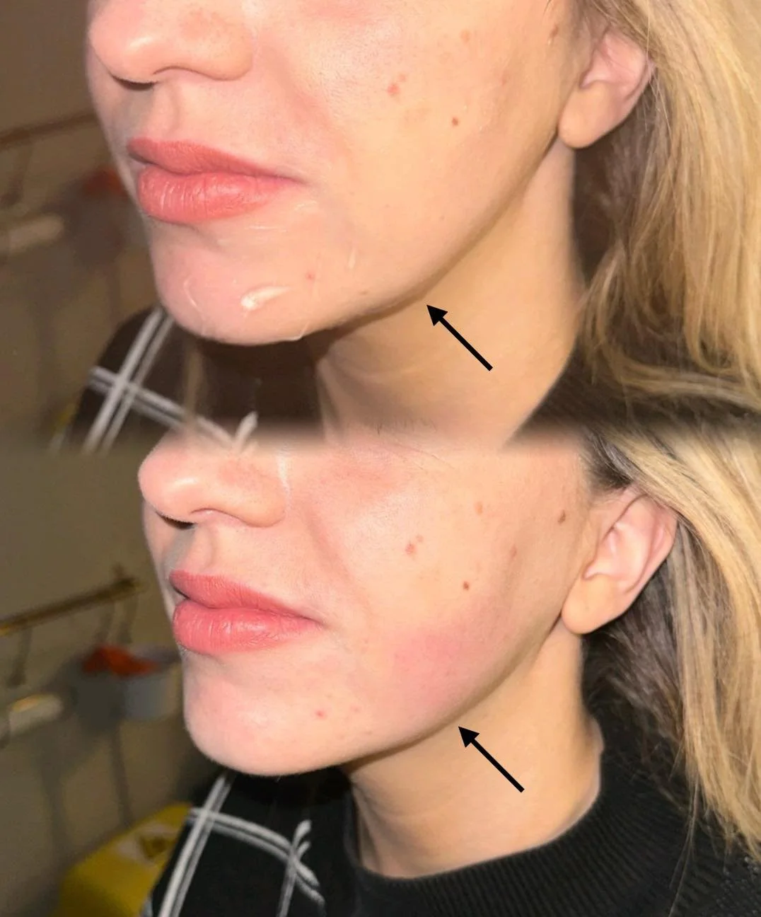 𝐉𝐨𝐰𝐥𝐬

A jowl refers to the sagging skin and tissue that can develop along the lower jawline and chin, typically due to aging. This happens when the skin loses elasticity, and the underlying fat and tissues shift downward, often influenced by gr