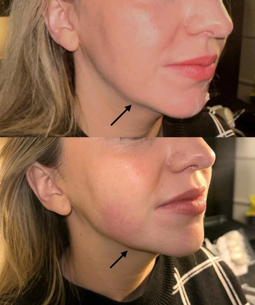 HIFU is the best skin-tightening treatment for those seeking natural, non-invasive, and long-lasting results without the risks and downtime associated with surgery. It&rsquo;s particularly effective for individuals with mild to moderate skin laxity w