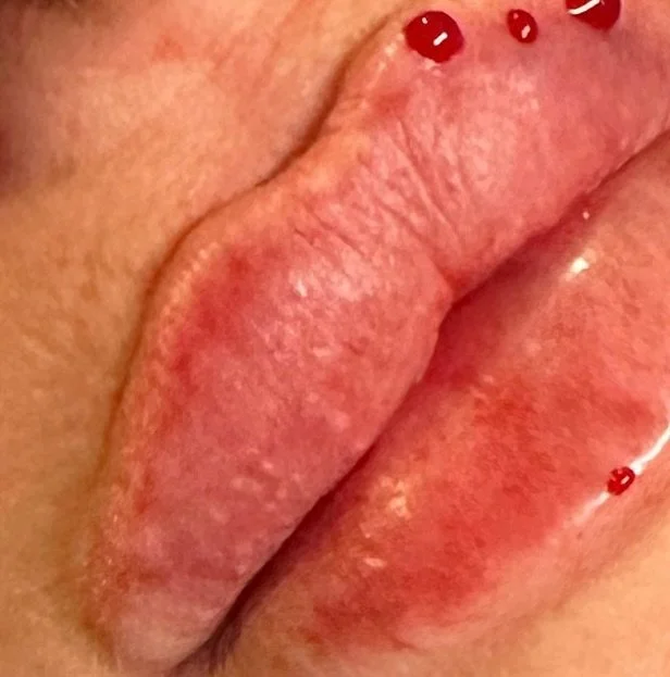 Up close 😝

📍Haddington, East Lothian
𝐖𝐞𝐛𝐬𝐢𝐭𝐞: www.lmahaddington.co.uk
𝐁𝐨𝐨𝐤𝐢𝐧𝐠: https://lmahaddington.book.app/book-now
𝐄𝐦𝐚𝐢𝐥: info@lmathestudio.com

#lipfiller #lips #aesthetics #lma #beauty #dermalfillers #lipinjections #filler