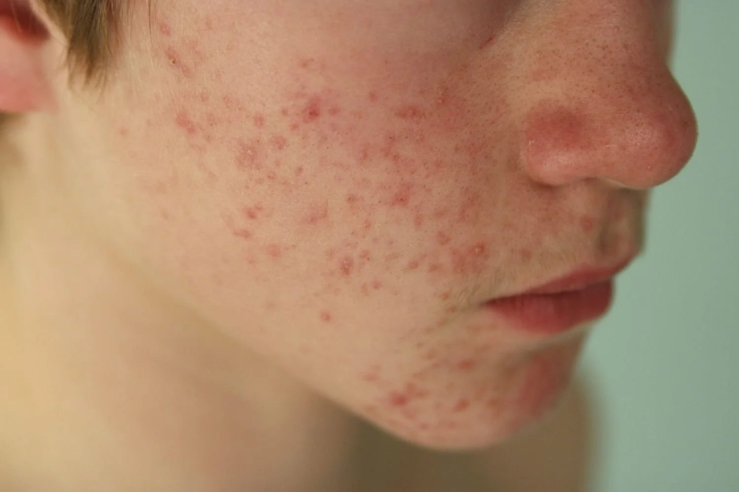 LED Light Therapy with Skin Concerns