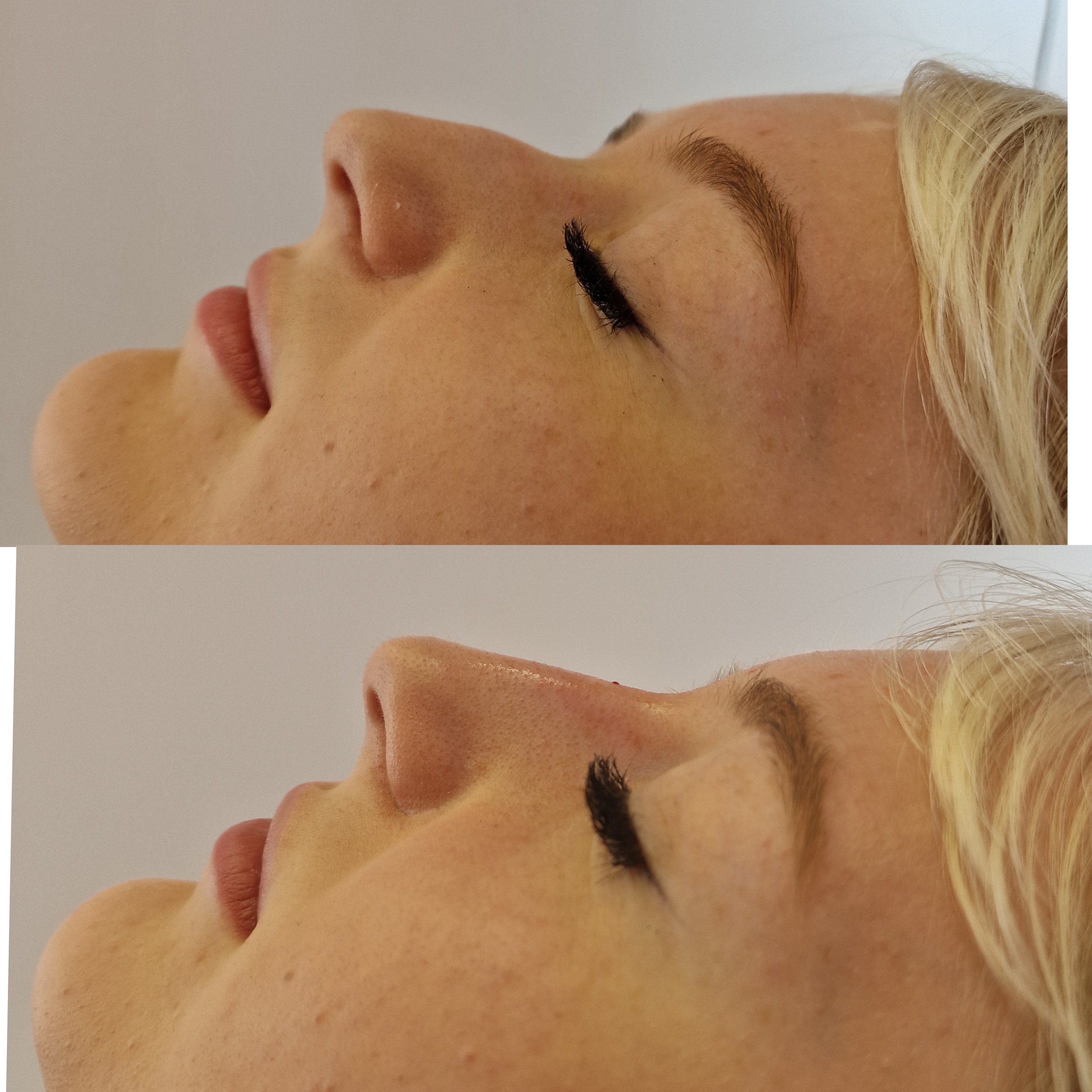 Nose filler to smooth out the bump giving a smooth apperance