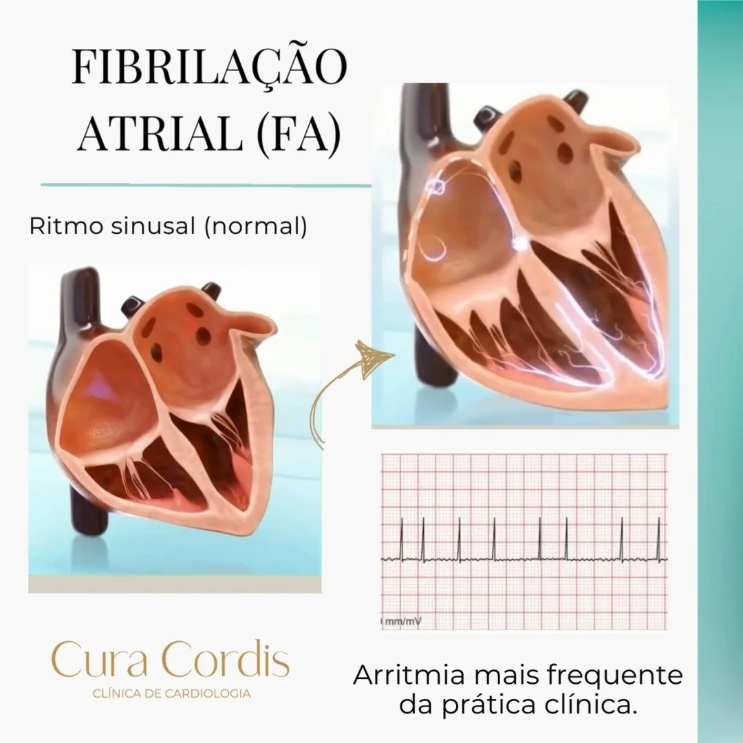 A fibrila&ccedil;&atilde;o atrial (FA) &eacute; uma arritmia card&iacute;aca comum que causa batimentos card&iacute;acos r&aacute;pidos e irregulares. Isso ocorre devido a uma desorganiza&ccedil;&atilde;o da atividade el&eacute;trica nos &aacute;trio