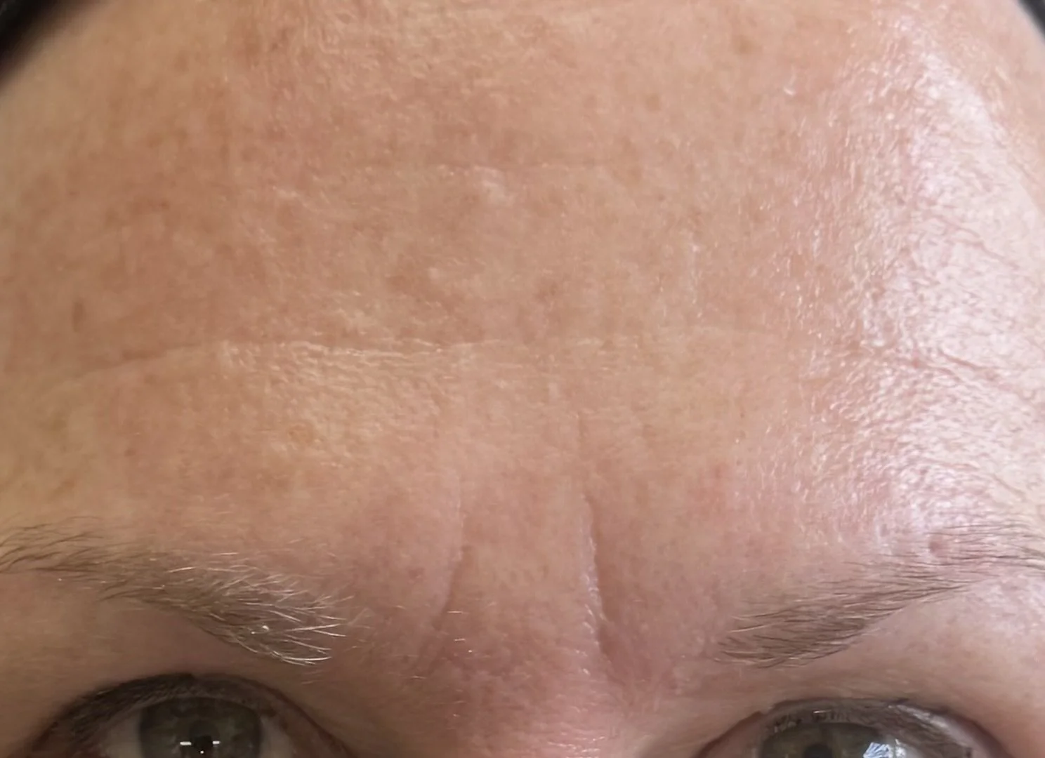 Fine line & Wrinkles
