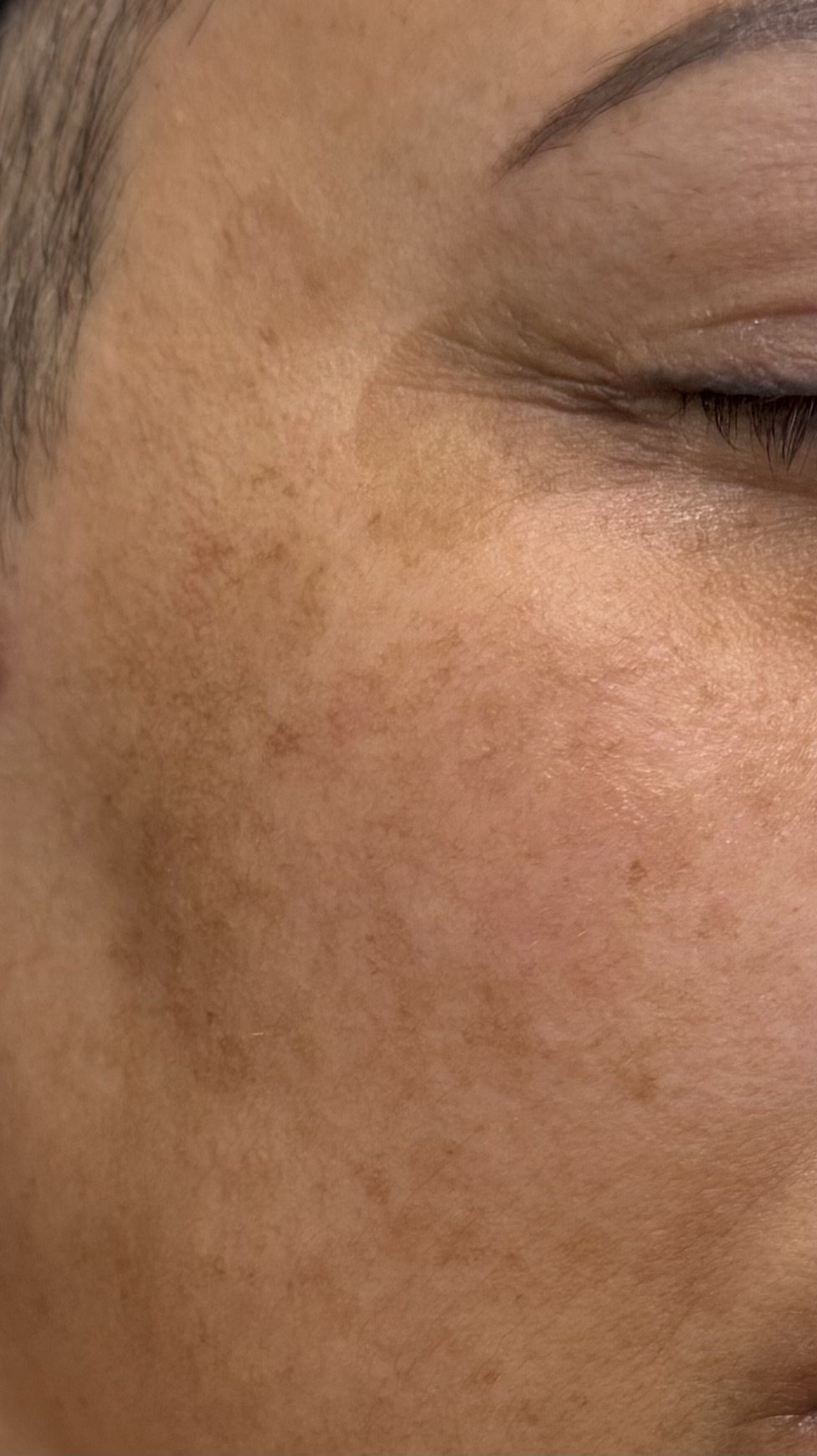 Sun Damage & Pigmentation