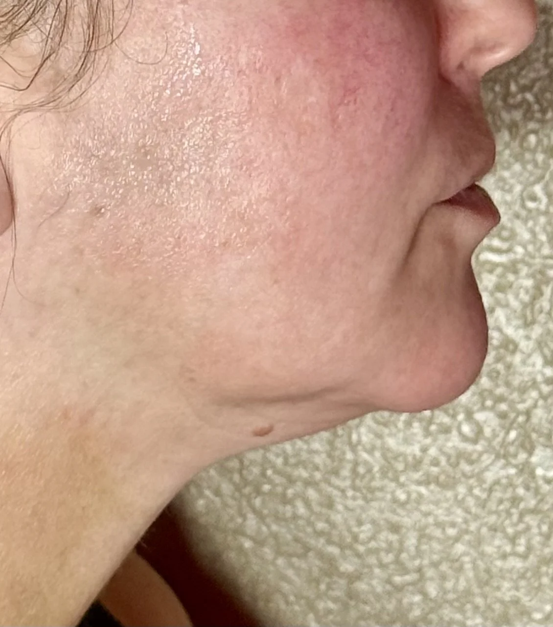 Skin Quality & Firmness