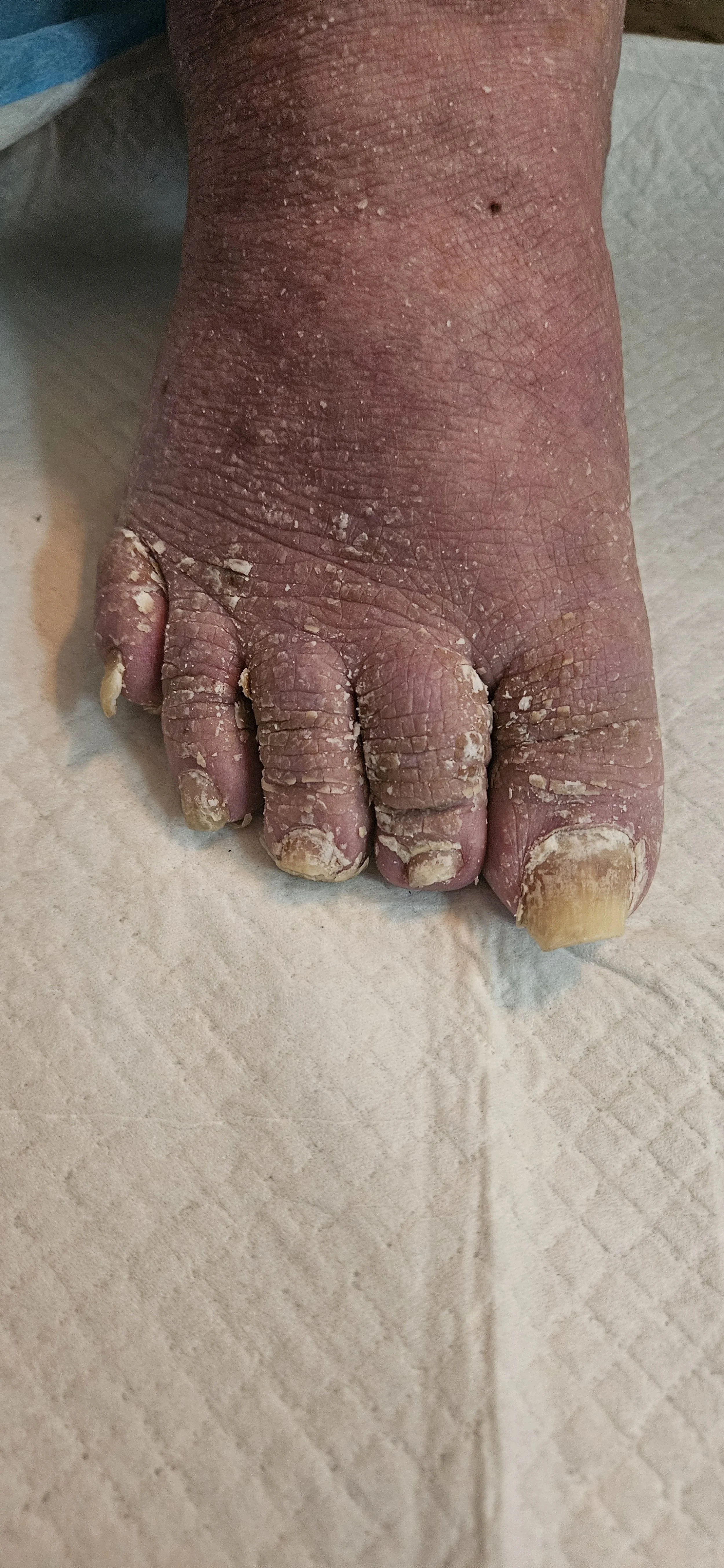 Waterless Pedicure-Before