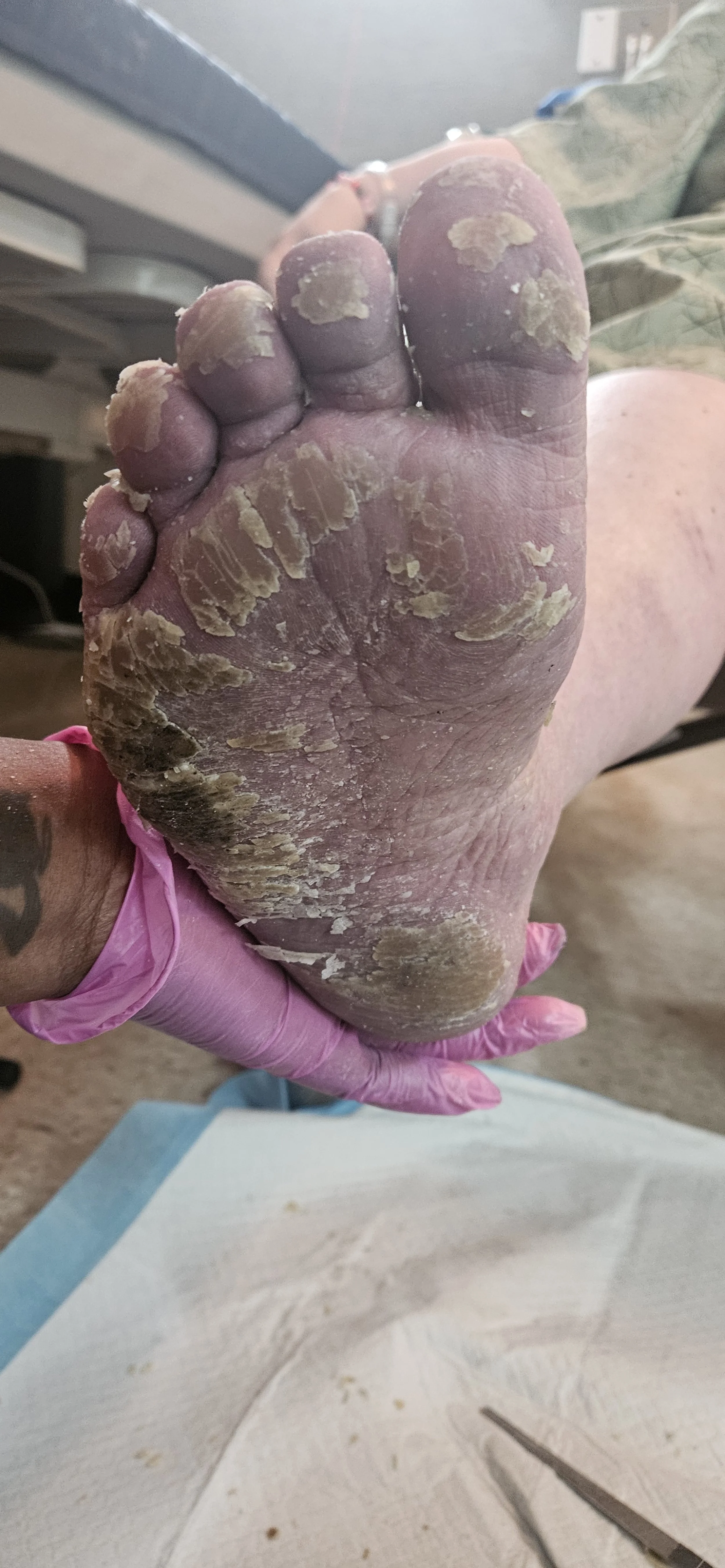 Waterless Pedicure-Before