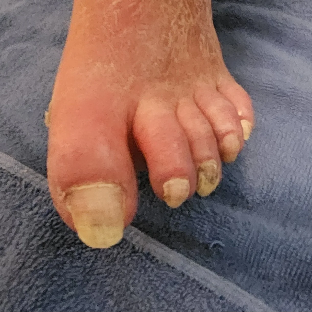 Waterless Pedicure with Polish-Before