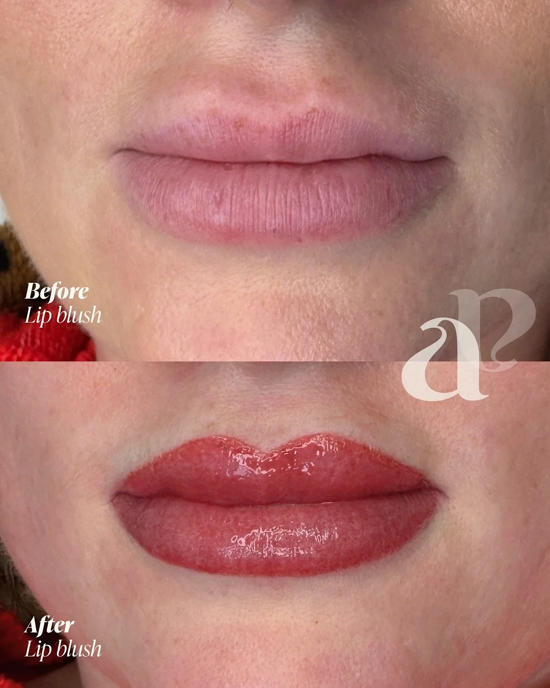 You don&rsquo;t need more filler (you need lip blush) 👄💄

This transformation shows how the two can work together, to give you the benefits of both&hellip;

💉 If you want more volume in your lips, filler is the only treatment that can achieve this