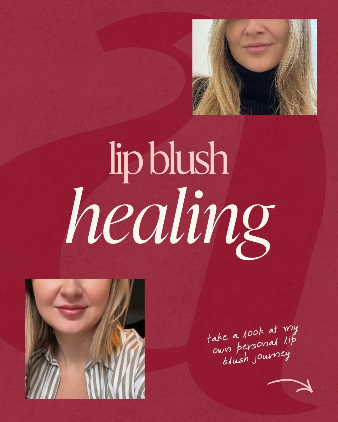 Let&rsquo;s talk about the healing process ❤️&zwj;🩹 (because I know that&rsquo;s what scares some people, but it really shouldn&rsquo;t)&hellip;

*The photo quality is not great, these are my own lips and the befores were taken yeeears ago - I&rsquo