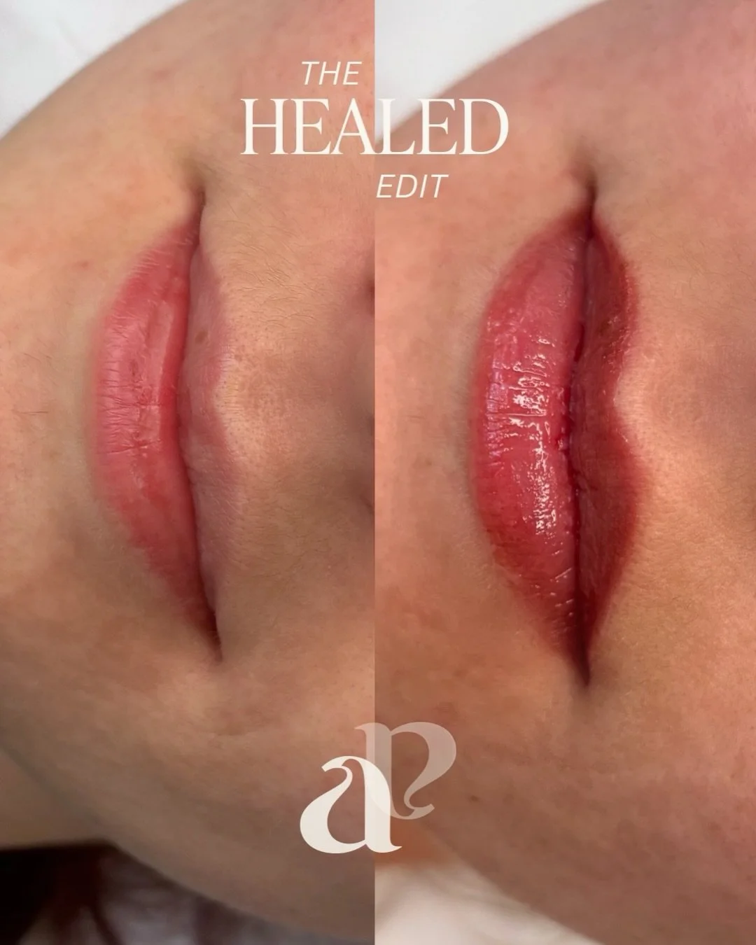 The HEALED edit 💕🌸 Blush edition.

These lips showcase just how natural lip blush heals - noticeable yes, but not obvious. It is not a lipstick effect - it&rsquo;s more of a semi-permanent lip tint. So you can wake up with colour in your lips, with