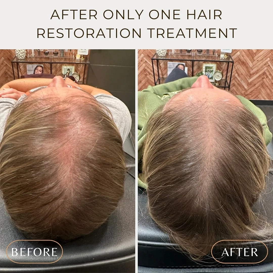 Can you believe this is after only ONE hair restoration treatment? We used both microneedling with DE|RIVE and PRP injections. It's recommended to get 4 total treatments to see full results so imagine how full and luscious this client's hair is going