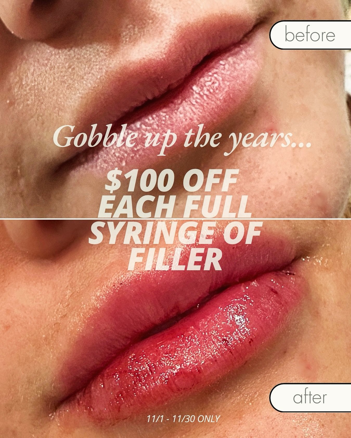 Get ready for all those holiday photos coming up with a filler feast! Throughout November get $100 OFF each syringe of filler! There's no limit to how many you can purchase. Apples to both Juvederm and Restylane products. You can use your Alle and As