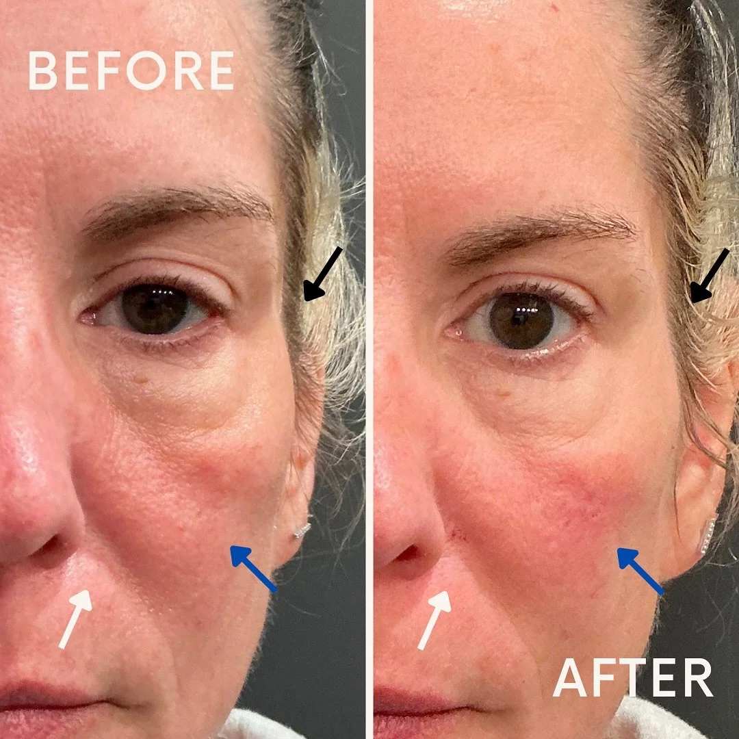 Temple hollowing is one of areas that ages us the most. We tend to lose volume in our temples over the years. But don't you fear, @juvederm Voluma has recently been FDA approved to treat the temples! 

You can see the transformation on this client. I