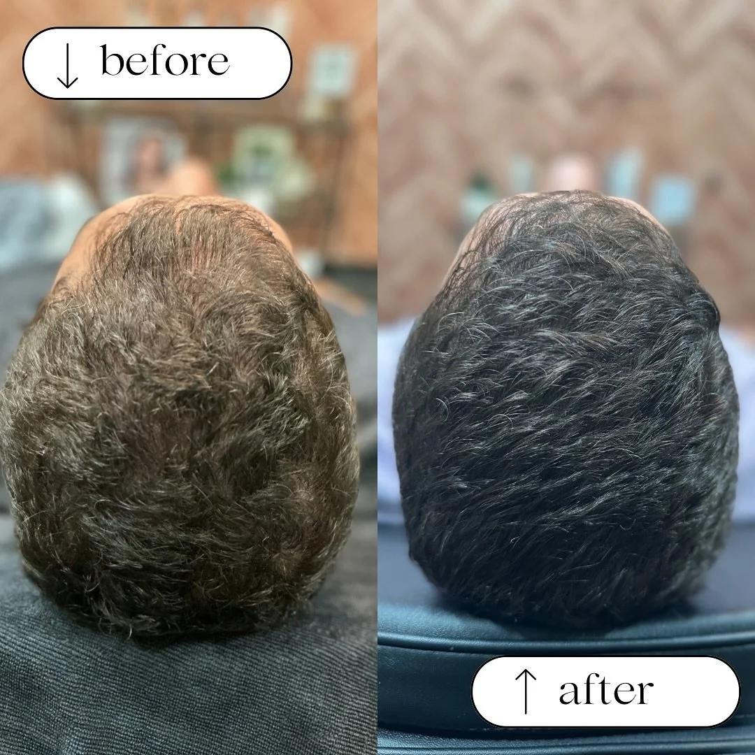 Do you have early hair thinning?? That's actually the best time to start hair restoration! You can see in the before photo there are patches of obvious thinning but after just ONE session, the hair is more full and uniform. 

It's recommended to get 