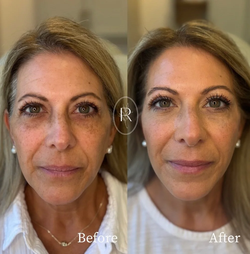Have you ever looked at someone and thought they looked refreshed and rejuvenated but couldn&rsquo;t quite pinpoint what they did?! 

Check out this remarkable transformation showcasing the power of injectable hyaluronic acid (yes, filler!) . Our gor