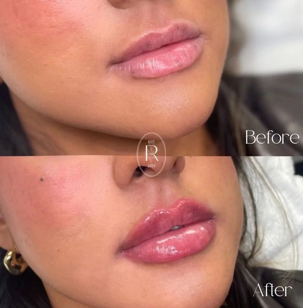 POV: you discovered your lips full potential 😍

At @renewaesthetics.ny we pride ourselves in creating beautiful, natural looking results.  You don&rsquo;t ever have to worry about looking overfilled, overdone or fake. After all, the best injectables