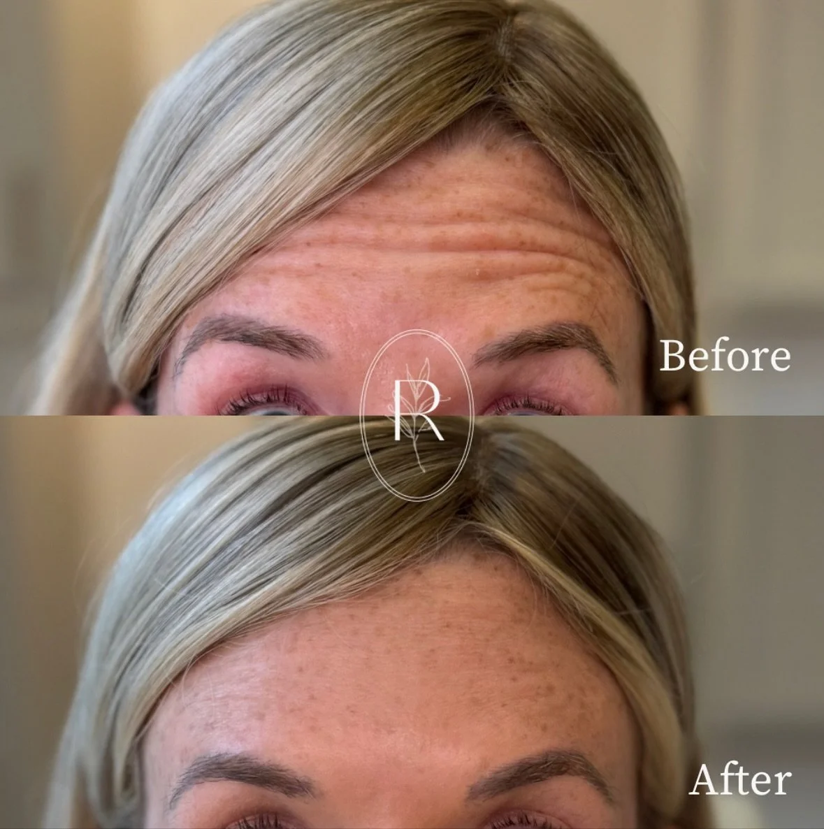 No tricks here! Just a smooth forehead and snatched jawline 😍

Happy Halloween!! 👻 🎃

_____________________________

Team:
👨🏼&zwj;⚕️Robert Freeman, MD @drfreemanmed 
👩🏼&zwj;⚕️Heather Freeman, PA-C
👩🏾&zwj;⚕️Gimi Mathai, PA-C @gimi_mathai_pa 
