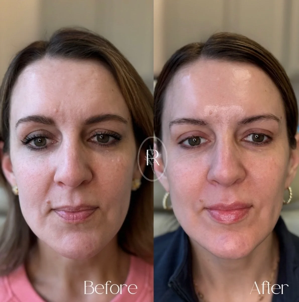 Let&rsquo;s close out this week with one of my favorite ✨LASER ✨ before and afters. 

Bright, Glowing, healthy skin is our specialty 🤩