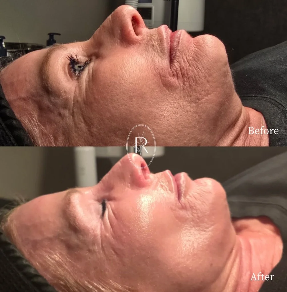 ✨ Real skin. Real results. ✨

This transformation was achieved using a customized combination of laser resurfacing and Glo2Facial&reg; with RF, selected to address texture, tone, pore visibility, and overall skin vitality&mdash;without overcorrecting