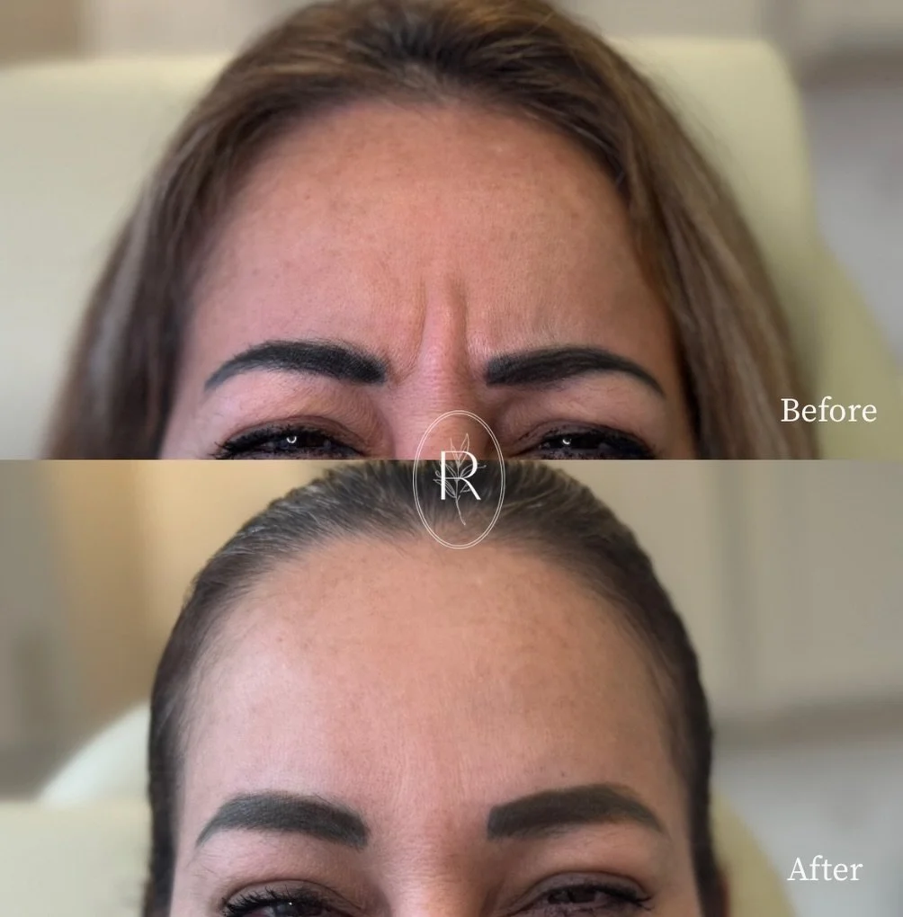 Natural and refreshed ✨

This is what Botox goals look like here 

Is this your vibe?