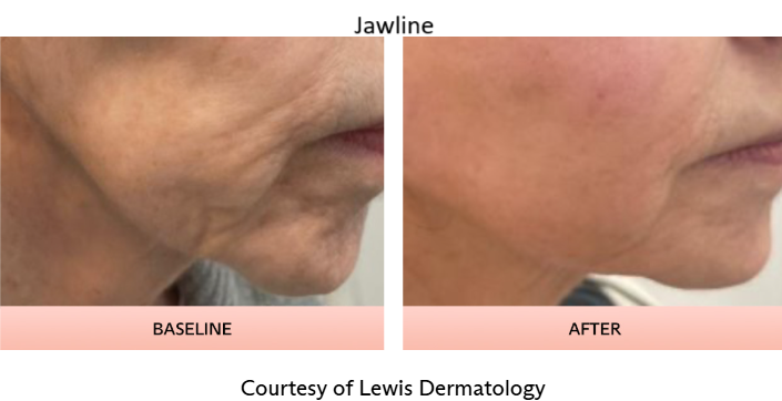 TriLift Jaw.png