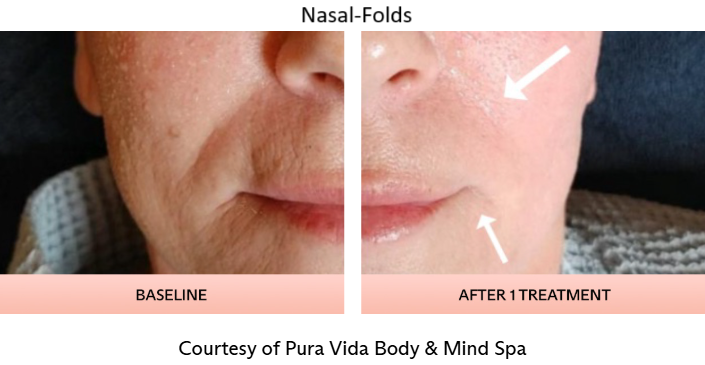 TriLift Nasal-Folds.png