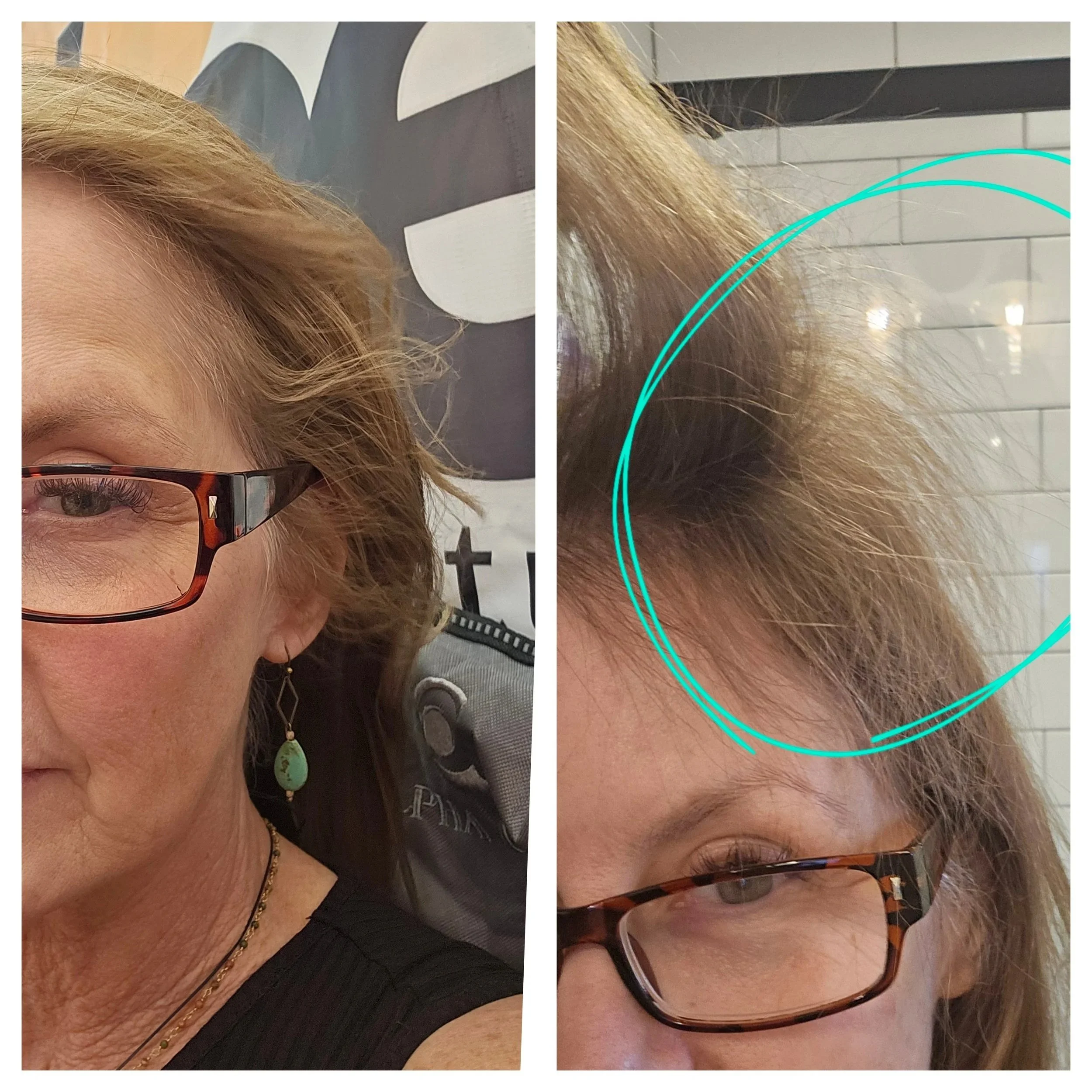 Side-by-side close-up photos of a person’s hairline and crown showing increased hair density and new growth after 16 weeks of consistent scalp oil use.