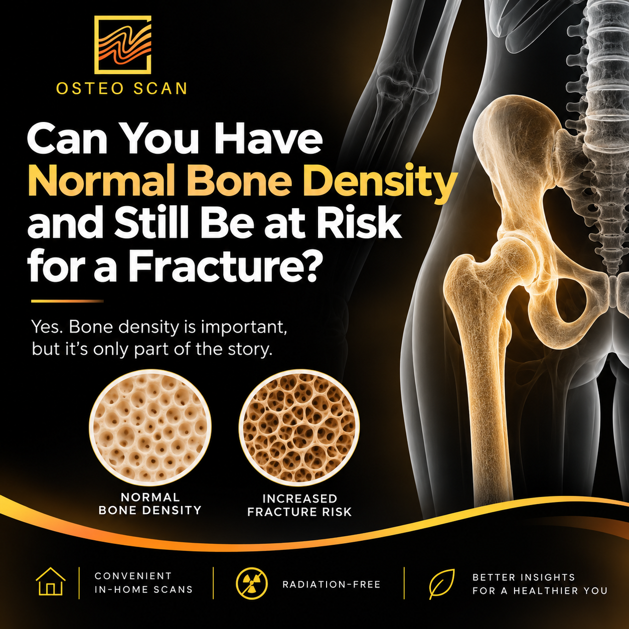 Can You Have Normal Bone Density and Still Be at Risk for a Fracture?