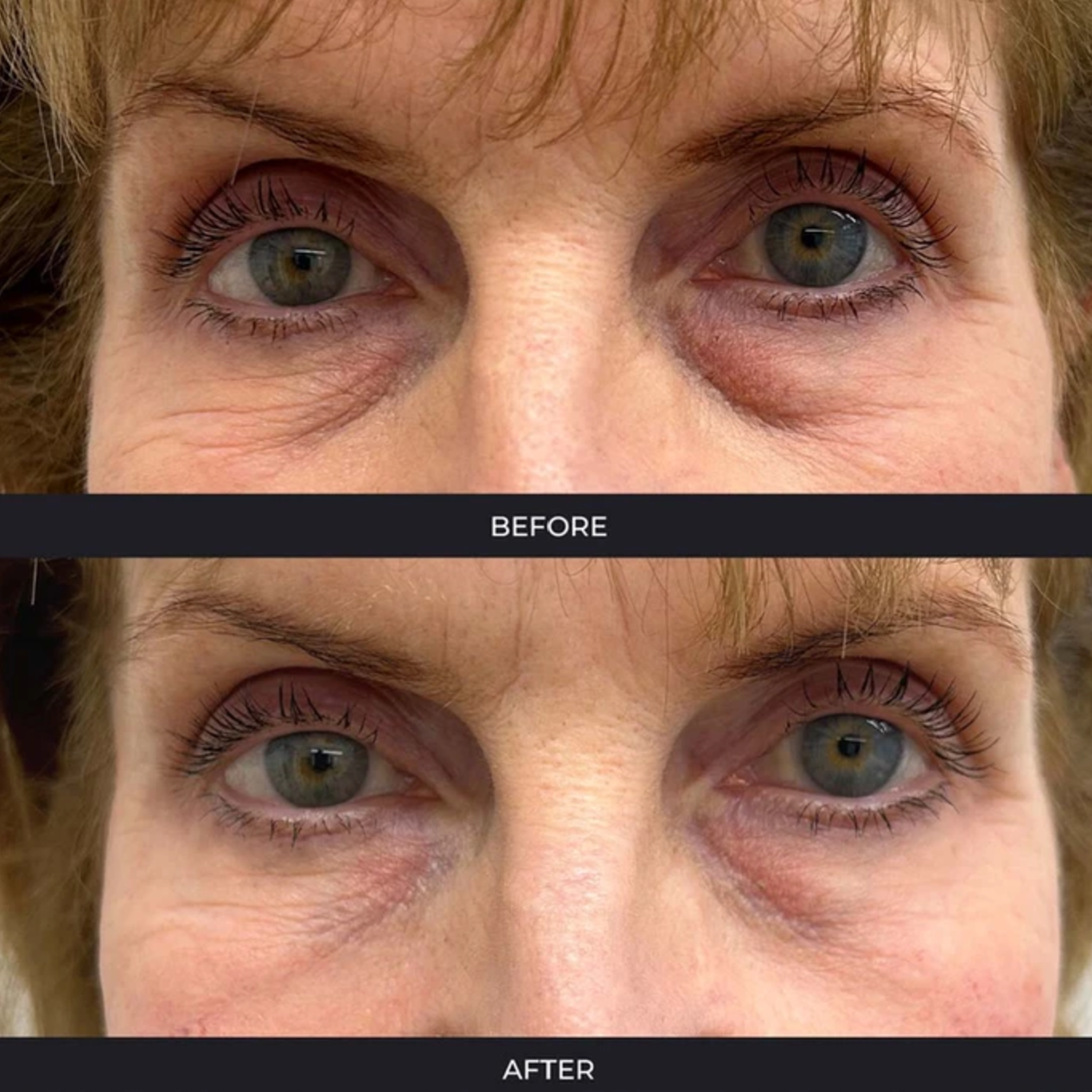 Eye bags and under eye wrinkle collagen builder