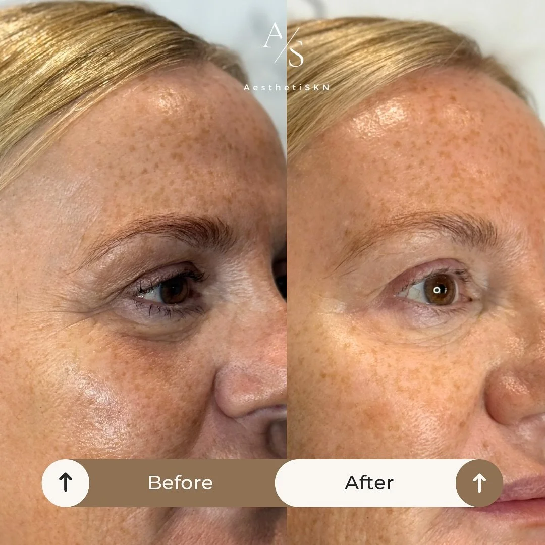 Polynucleotides work beneath the skin to restore hydration, smoothness, and radiance &mdash; leaving the under-eye area brighter and refreshed without changing your natural features.

Here&rsquo;s what makes the after so special 👇
	1.	Under-eye brig
