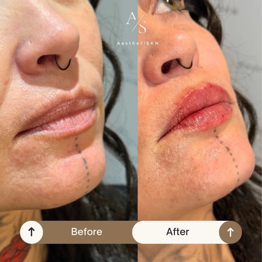 Soft, hydrated, and naturally defined ✨💋

.
#LipFiller #NaturalLips #LipEnhancement #LipAugmentation #DermalFillers #AestheticsClinic #Manchester #wilmslow #stokeontrent #MedicalAesthetics #NaturalResults #level7