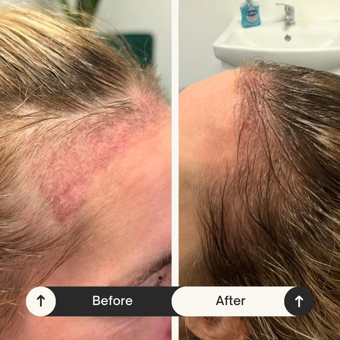 PRP after a hair transplant ✨
Platelet-Rich Plasma helps support graft survival, improves scalp health, and encourages stronger, healthier hair regrowth post-transplant.

Ideal for:
✔️ Enhancing healing
✔️ Improving hair density
✔️ Supporting long-te