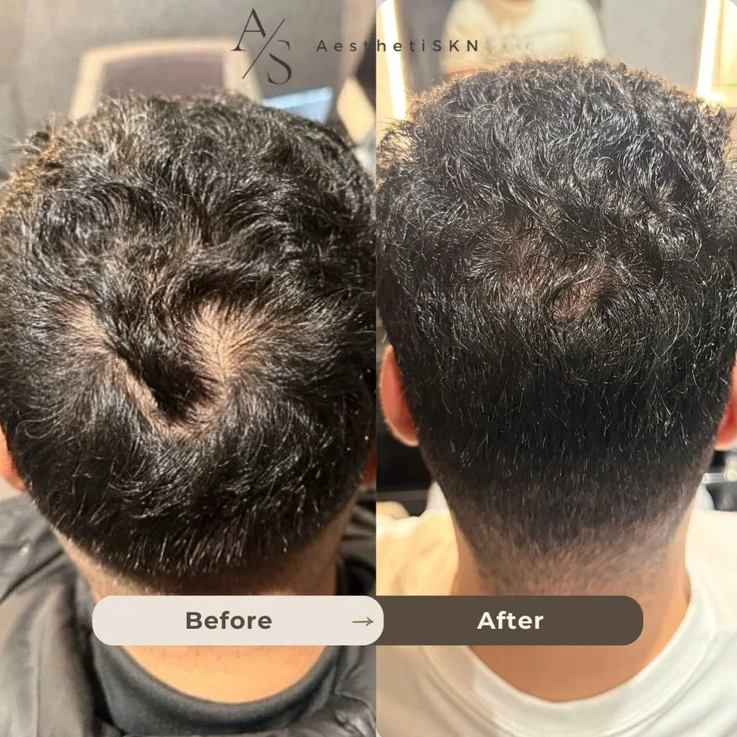 Things take time&hellip; and every scalp is unique.
Every pattern of hair loss is different &mdash; which is why I don&rsquo;t do &ldquo;one-size-fits-all&rdquo; treatments.

This transformation came from a personalised treatment plan, tailored to:
&