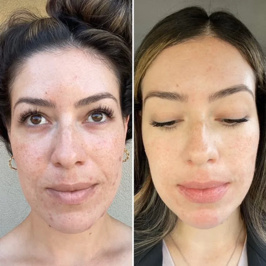 Microneedling at AesthetiSKN