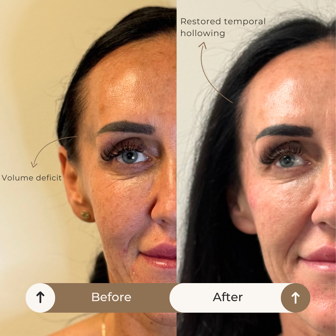 Temple Derma Filler - Before and after. Wilmslow cheshire 
 