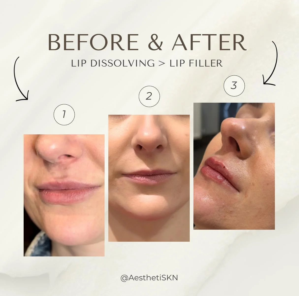 Lip dissolving and lip filler- subtle enhancement - stoke on trent staffordshire