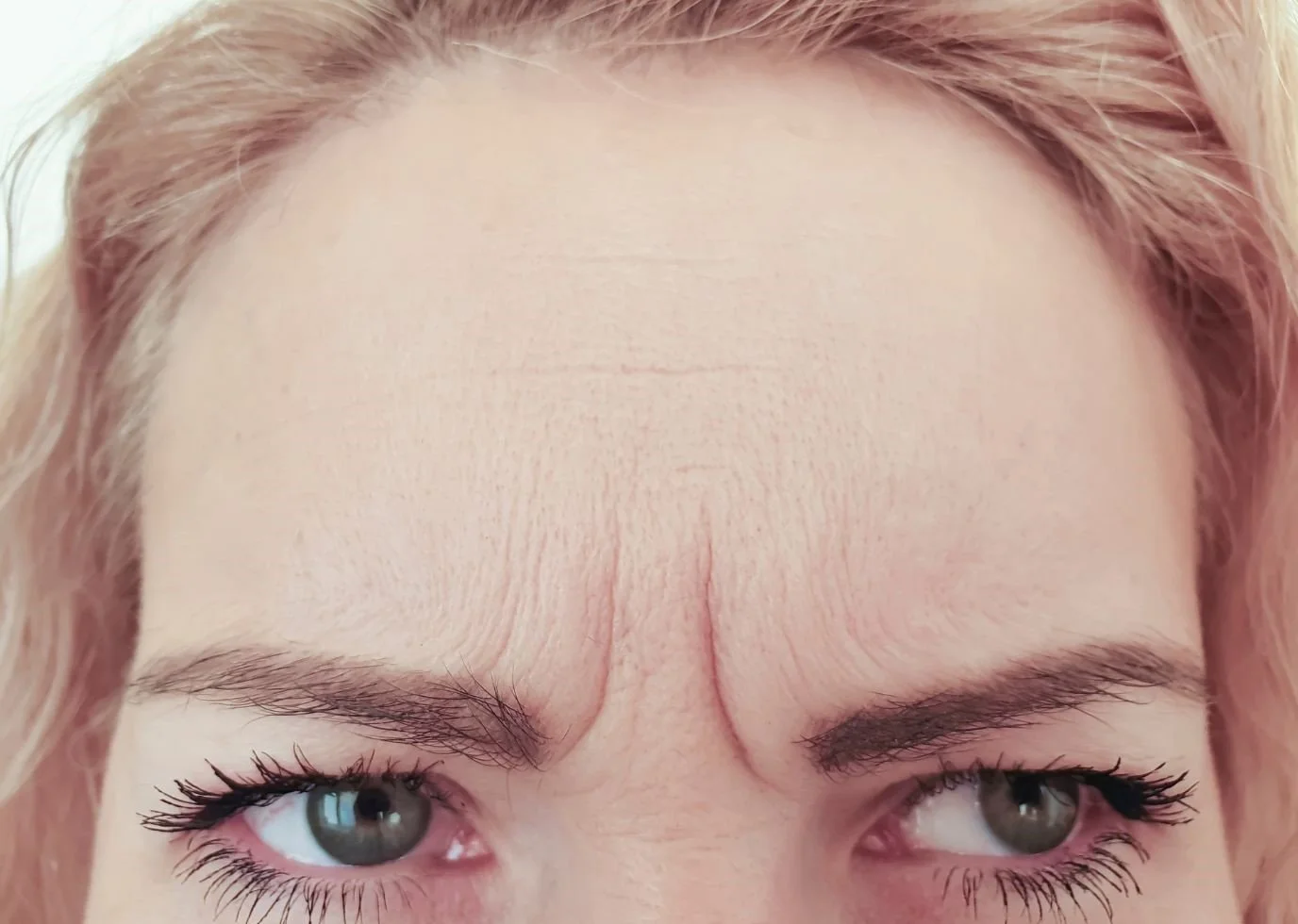 glabella_forehead_11s_line_botox_anti_wrinkle.jpg