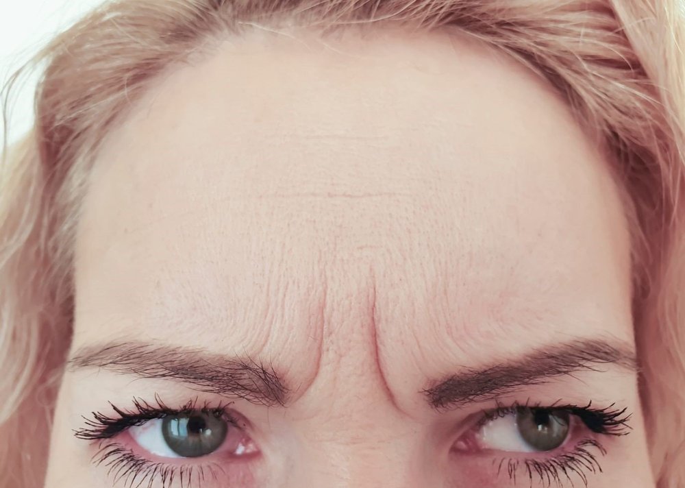 Frown lines between the eyebrows
