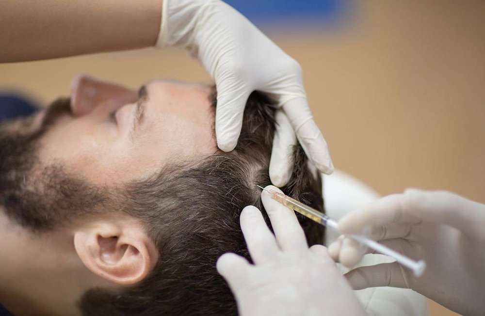 PRP scalp treatment for hair thinning and hair loss