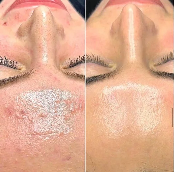 Chemical Peels at AesthetiSKN