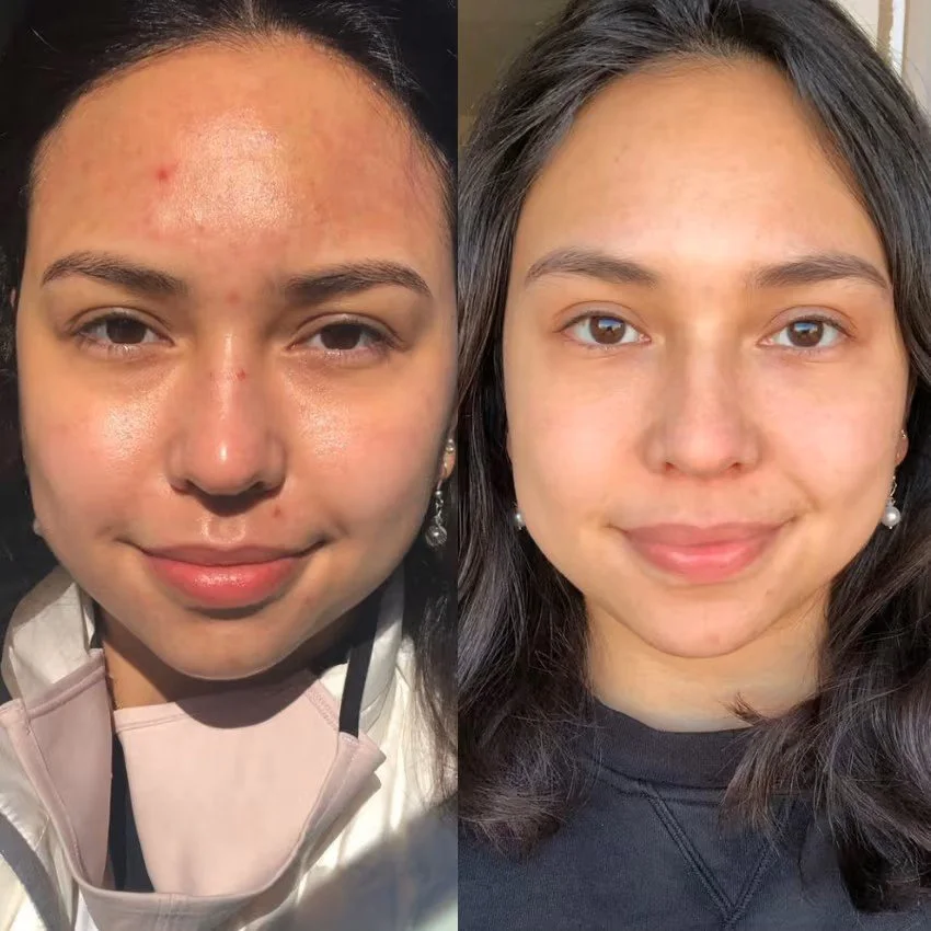 Skin before and after treatment course