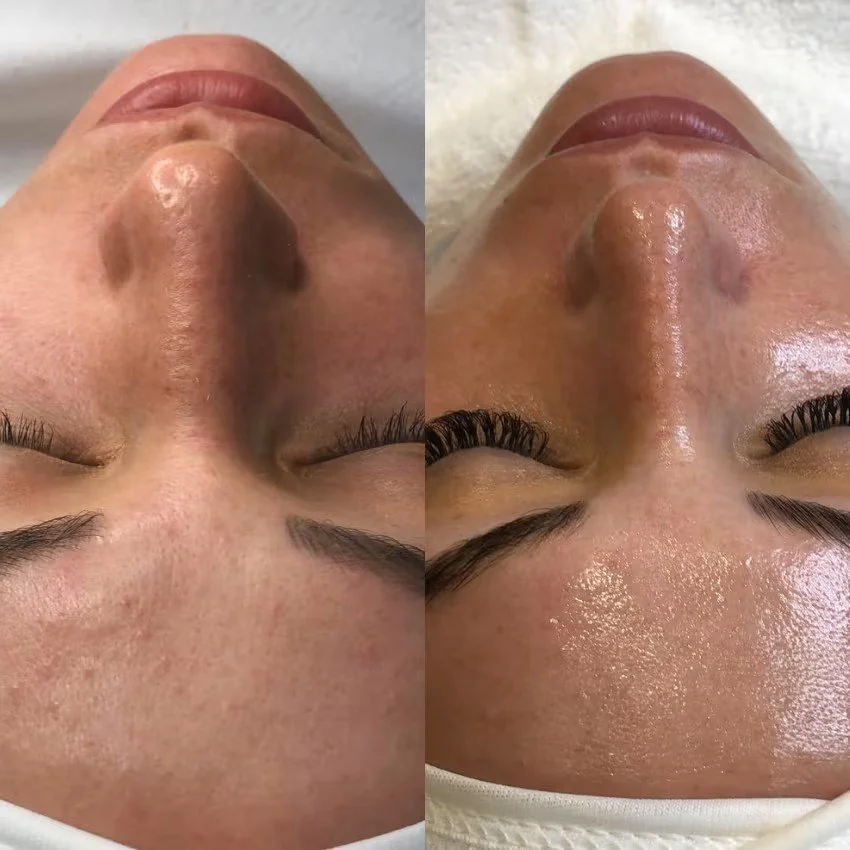 Skin texture before and after microneedling