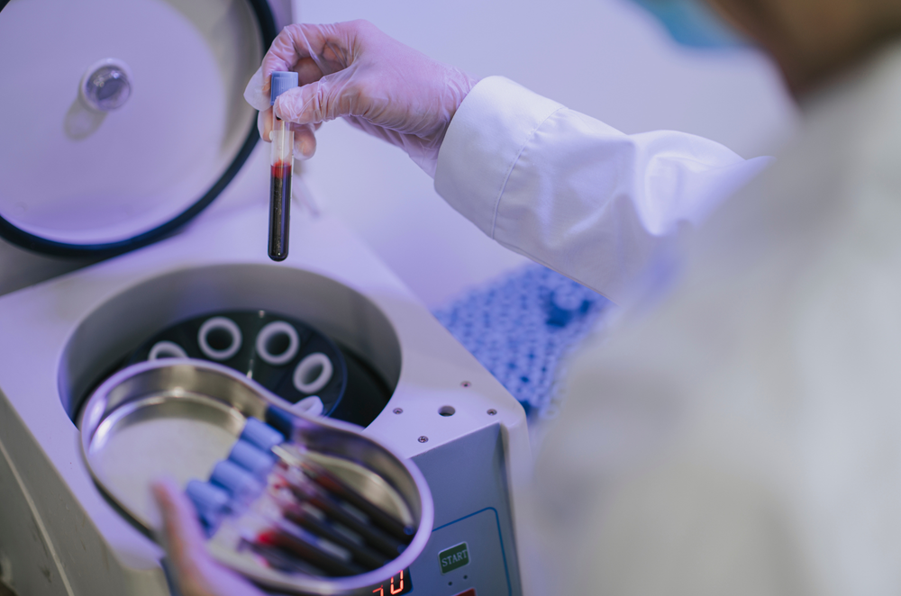 PRP Therapy at AesthetiSKN